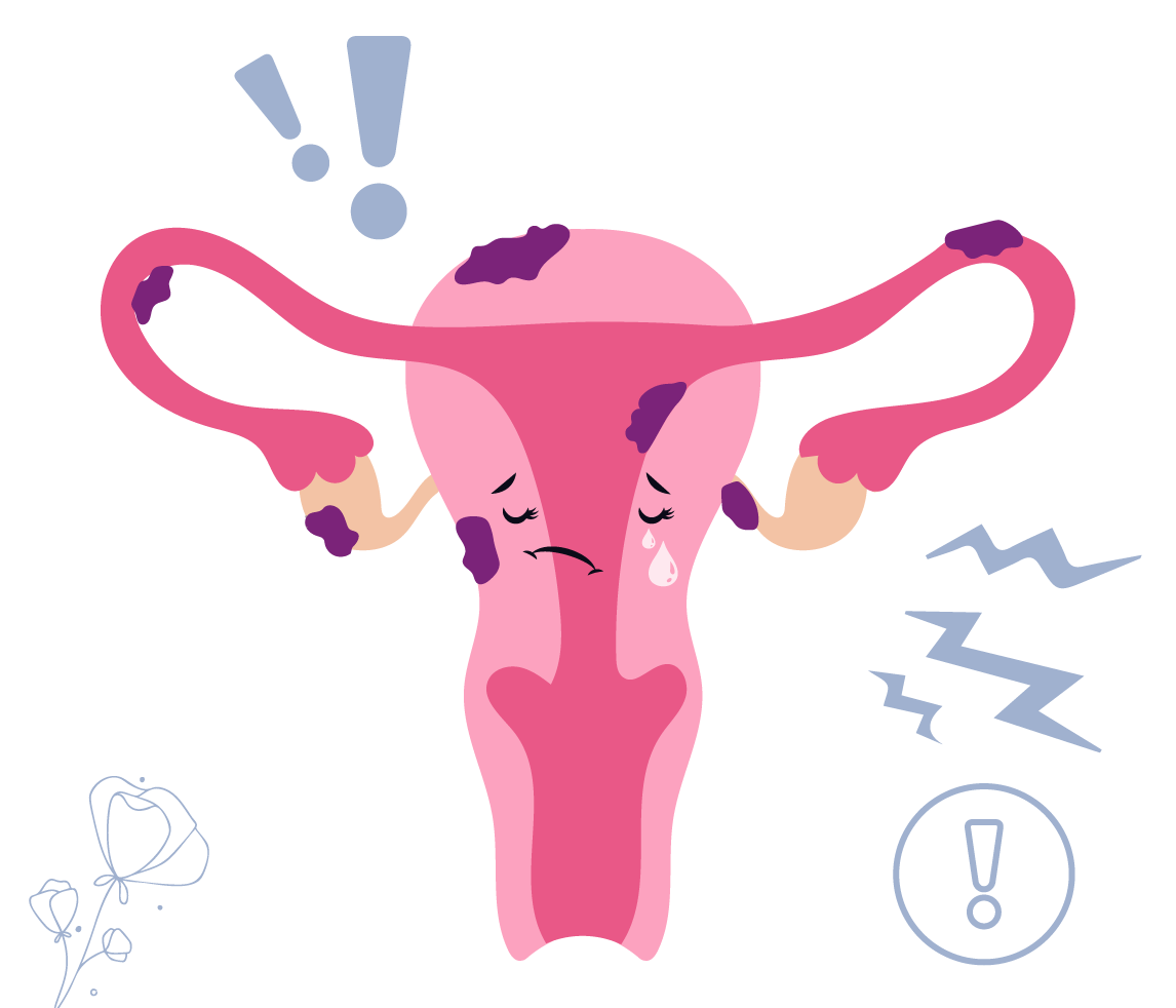 Doliral_endometriosis