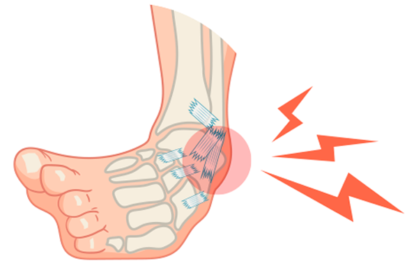 tenflex esguince ligamentos